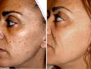 IPL /Photofacial Washington DC & Virginia IPL /Photofacial Washington DC & Virginia